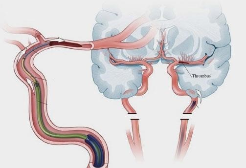 blood clot ‘thrombus’ causing the stroke, and the guide wire going up the vessel to reach and remove the clot.