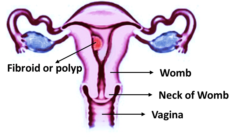 Fibroid or polyp in womb