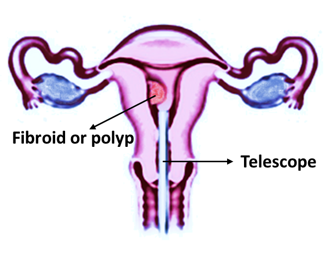 Fibroid or polyp in womb and telescope