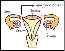 Female reproductive system and sperm after steralisation or tubal ligation
