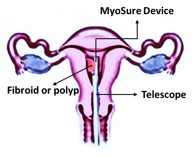 Fibroid or polyp in womb, telescope and MyoSure Device