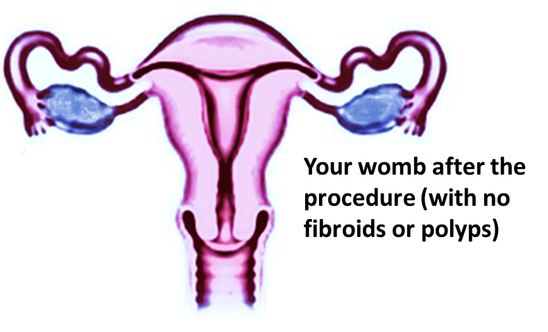 womb after procedure - no fibroids or polyps