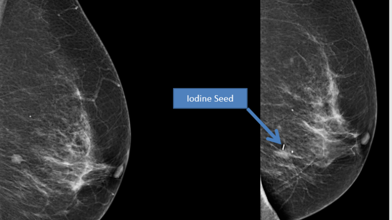 Breast scan showing how iodine seed helps surgeons